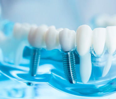 Implantes rápidos